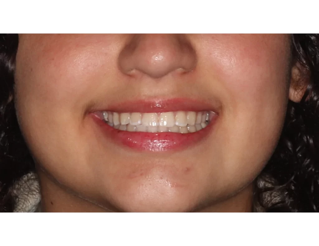 Smile Gallery for braces & Invisalign for adults, kids, & teens in Cupertino, Fremont, and Milpitas with Agape Orthodontics